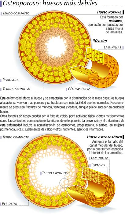 Osteoporosis: huesos más débiles