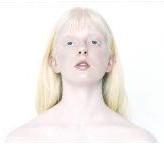 ¿A qué se debe el albinismo?
