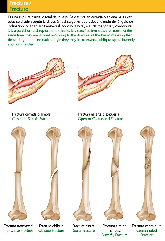 Fractura