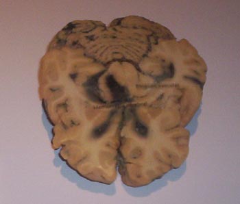 610481-jpg - Cerebro con hemorragia masiva.