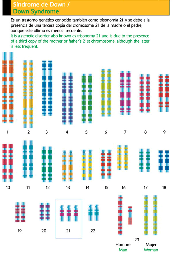 Síndrome de Down