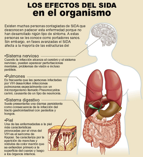 Efectos del Sida