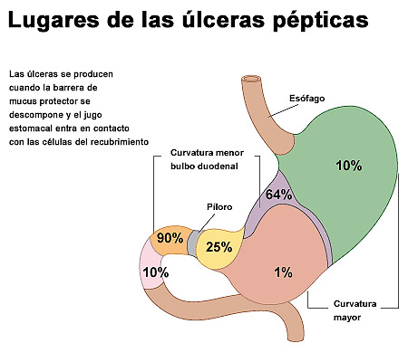 Lugares de las úlceras pépticas